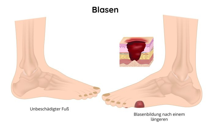 Blasenbildung auf dem Fuß