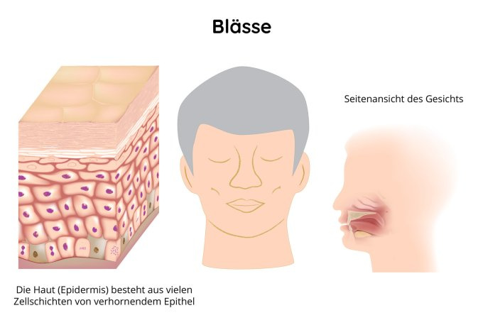 Blässe im Gesicht