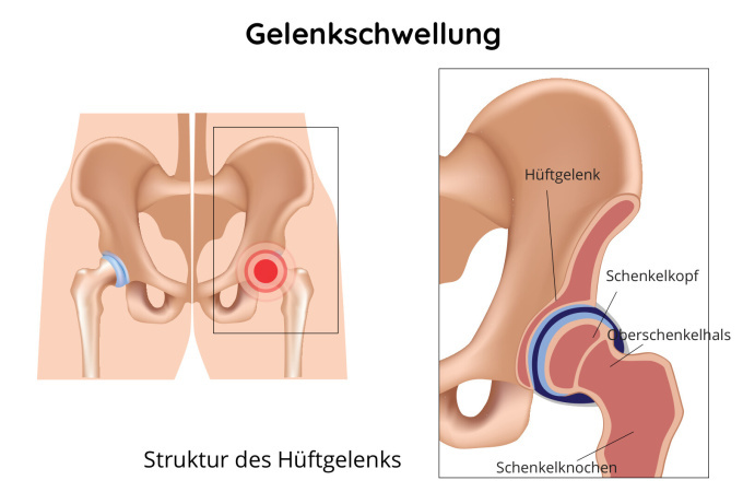 Schwellung des Hüftgelenks