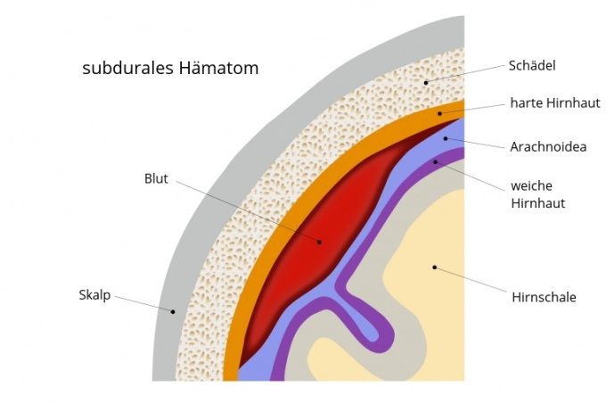 Subdurales Hämatom
