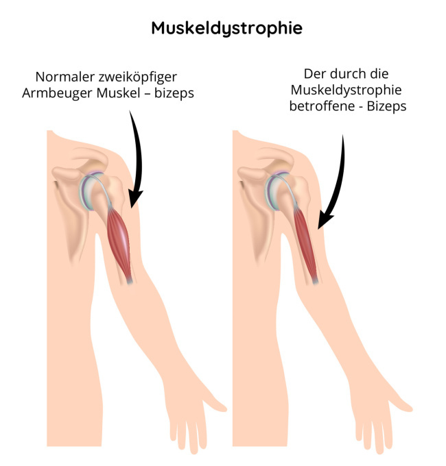 Muskeldystrophie