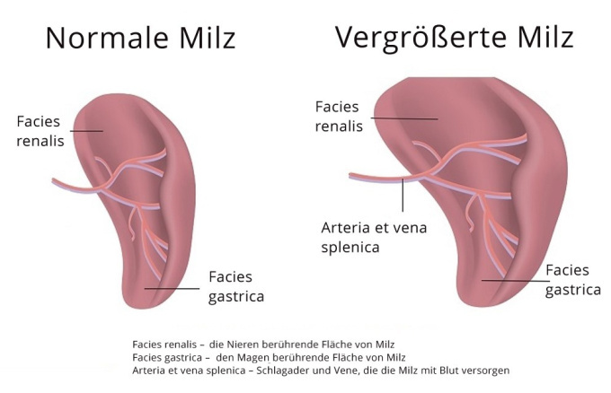 Vergrößerte Milz