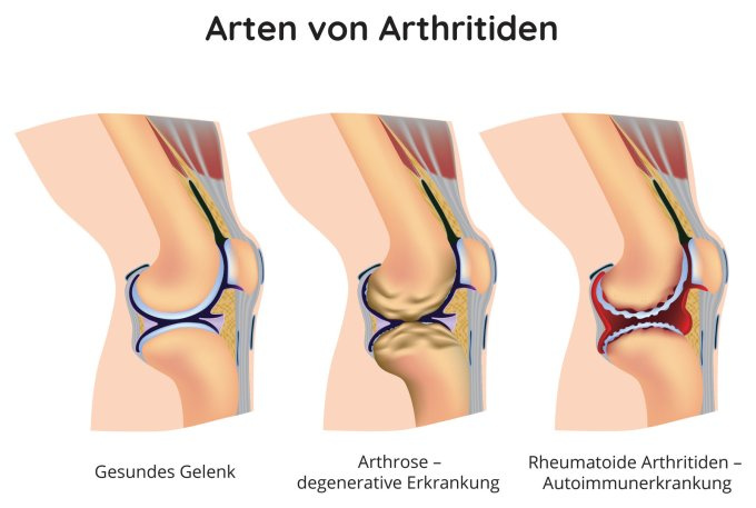 Arten von Arthritiden