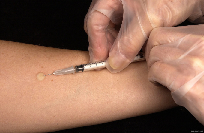 Allergietest