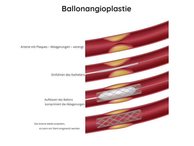 Ballonangioplastie