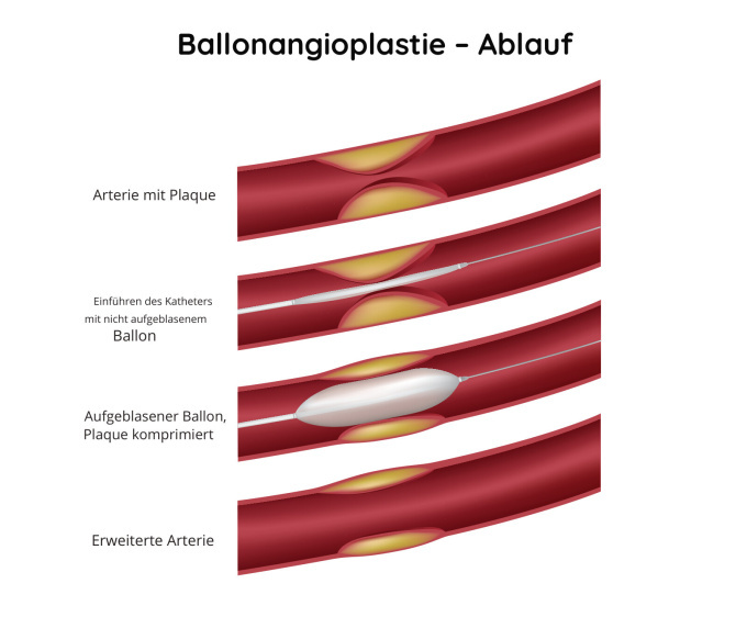 Ballonangioplastie – Ablauf