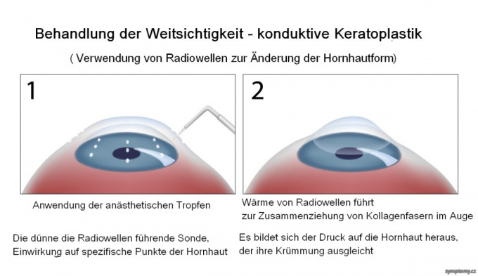 Konduktive Keratoplastik - Behandlung der Weitsichtigkeit
