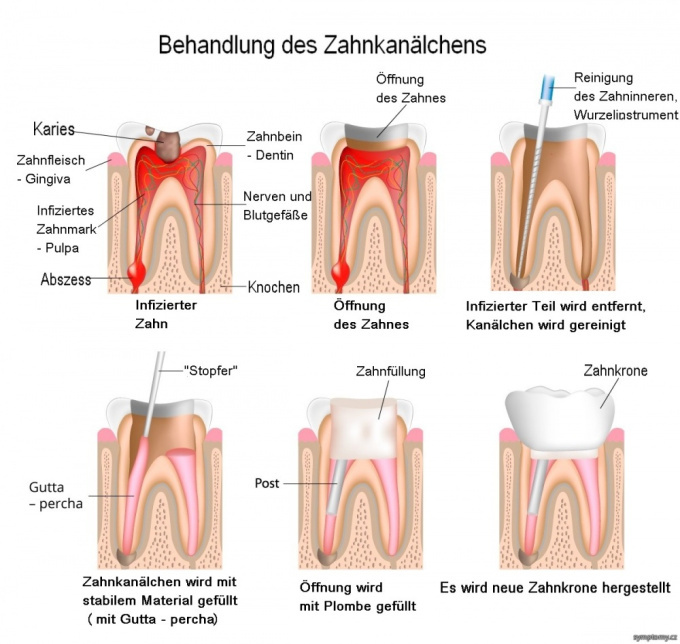 Behandlung des Zahnkanälchen
