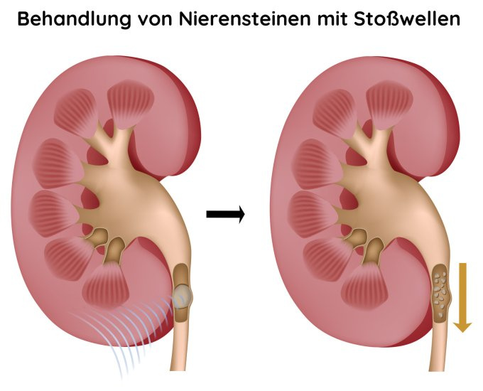 Behandlung von Nierensteinen durch Stoßwelle