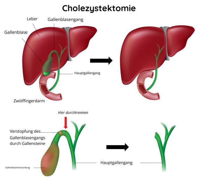 Cholezystektomie - Gallenblasenentfernung