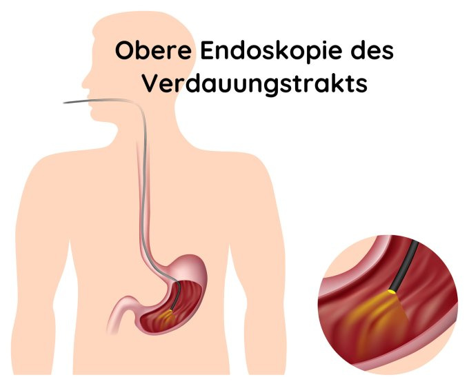 Gastroskopie