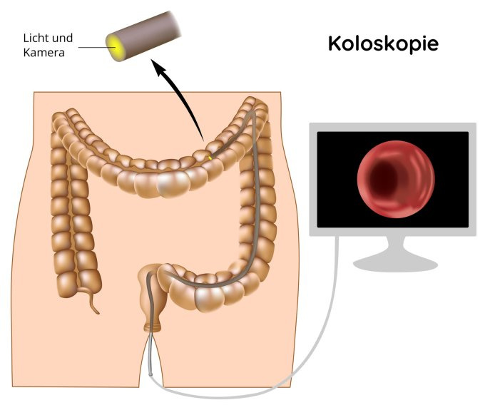 Koloskopie - Colonoskopie