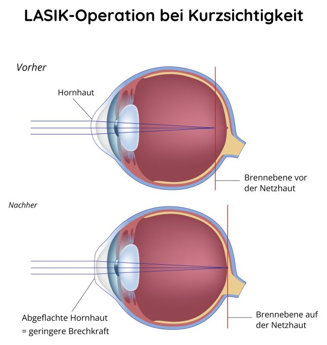 Laseroperation der Kurzsichtigkeit - LASIK