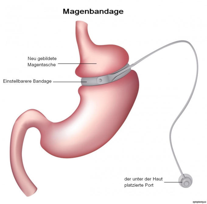 Magenbandage