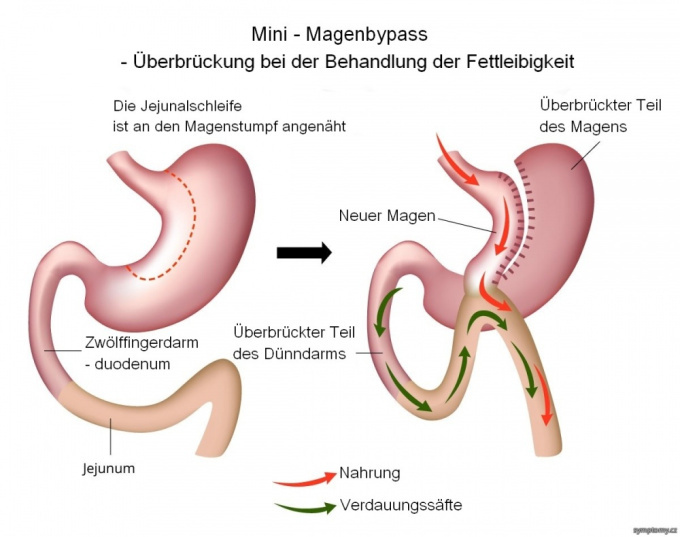 Mini-Magenbypass