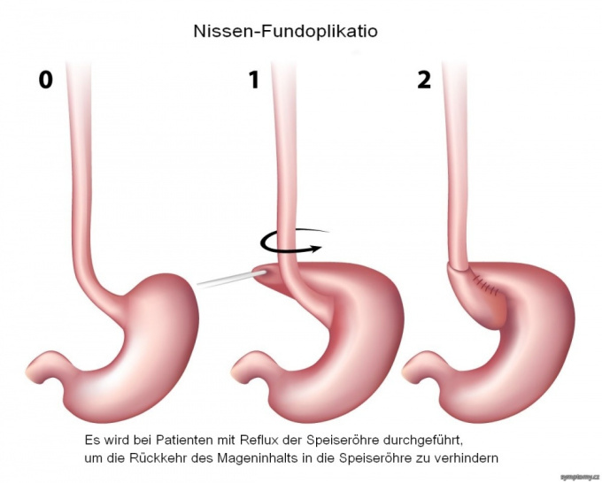 Nissen-Fundoplikatio
