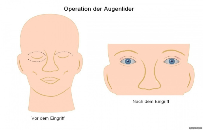 Operation der Augenlider