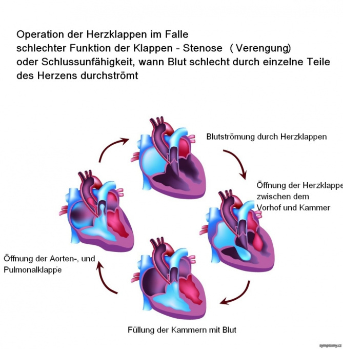Operation der Herzklappen