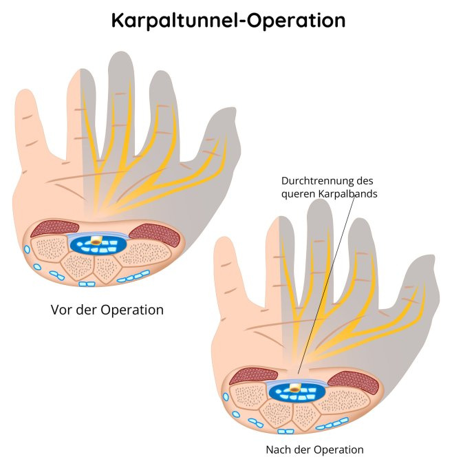 Operation des Karpaltunnels