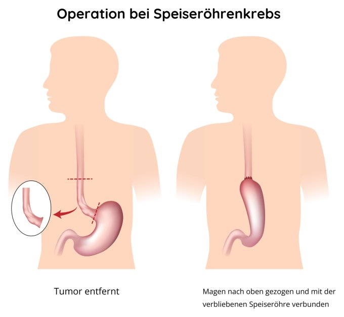 Chirurgische Lösung des Sepeiseröhrenkrebses