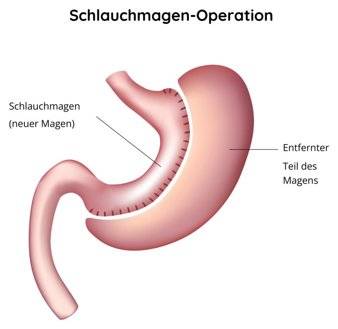 Schlauchmagen