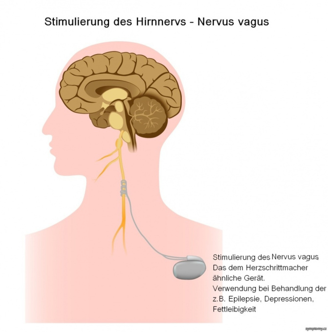 Stimulierung des Hirnnervs
