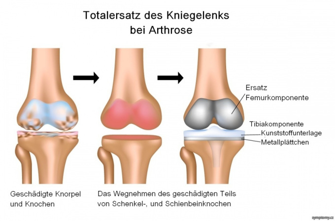 Totalersatz des Kniegelenks bei Arthrose