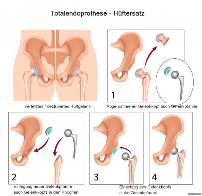Totalendoprothese - Hüftersatz