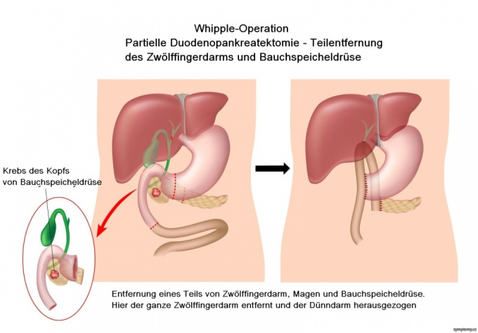 Whipple - Operation