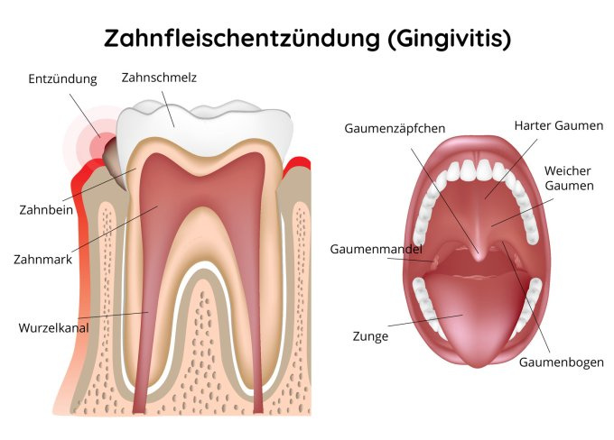 Schematische Darstellung der Zahnfleischentzündung