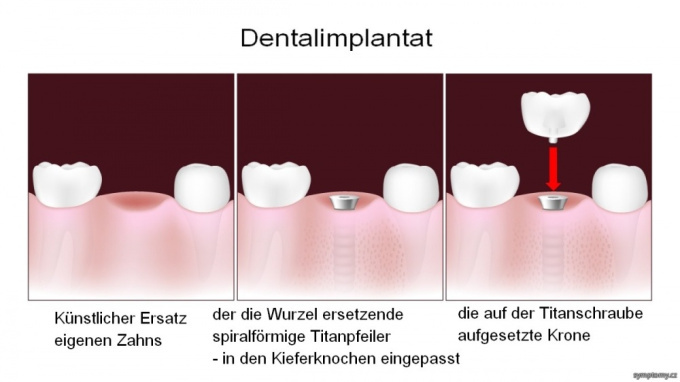 Dental-(Zahn-)implantat