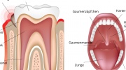 Zahnfleischentzündung