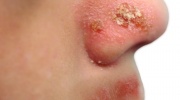 Impetigo