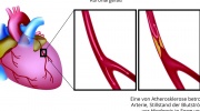 Ischämische Herzkrankheit