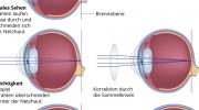 Kurzsichtigkeit