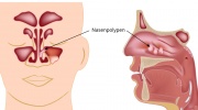 Nasenpolypen