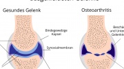 Osteoarthrose