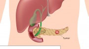 Bauchspeicheldrüsenkrebs