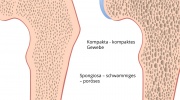 Osteoporose