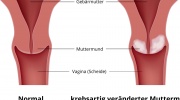 Gebärmutterhalskrebs