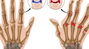 Rheumatoide Arthritis der Fingergelenke