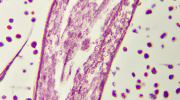 Arteriovenöse Malformation