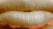Herpes
