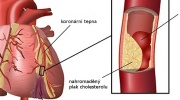 Myokardinfarkt