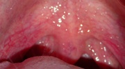 Laryngitis