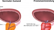 Prostataentzündung