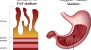 Peptisches Geschwür auf der Magenschleimhaut