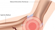 Bruch von Ellbogen und Unterarm
