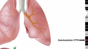 Zystische Fibrose