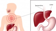 Ösophagitis